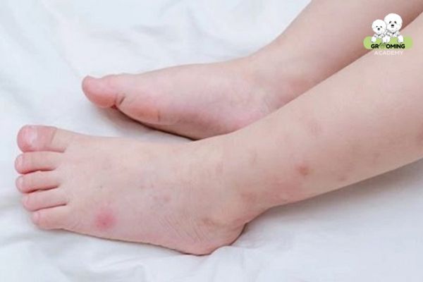 Triệu chứng khi bị ve chó cắn là gì? Triệu chứng khi bị ve chó cắn là gì?